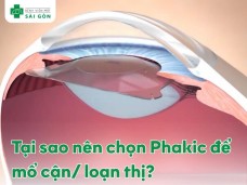Tại sao nên chọn Phakic/Phakic để mổ cận/ loạn thị?
