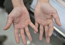 Liệt tứ chi vì 'thú vui' bóng cười