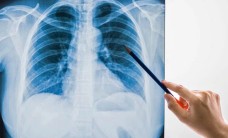 Những người có nguy cơ cao mắc bệnh phổi tắc nghẽn mạn tính