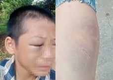 Bé trai 11 tuổi nghi bị bố và mẹ kế bạo hành ở Nghệ An: Công an vào cuộc