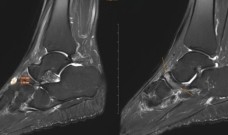 Nữ giáo viên đi khám đau cổ chân, bất ngờ phát hiện bị bệnh 'triệu người có một'