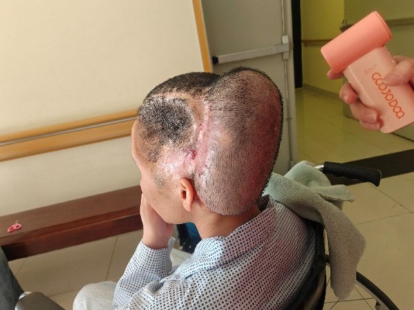 Đột quỵ sau hút mỡ làm đẹp