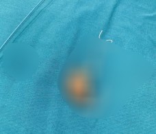 Người phụ nữ phát hiện sự thật sau 22 năm đặt vòng tránh thai