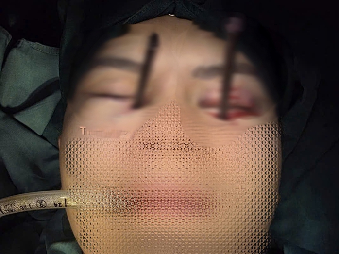 Cứu nam thanh niên bị dị vật đâm sâu hốc mắt - Ảnh 1.