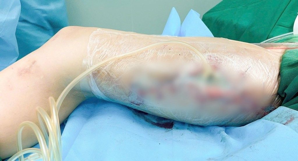 Một ca bị tai biến sau khi tiêm filler từ một cơ sở không phép hoai-tu.jpg