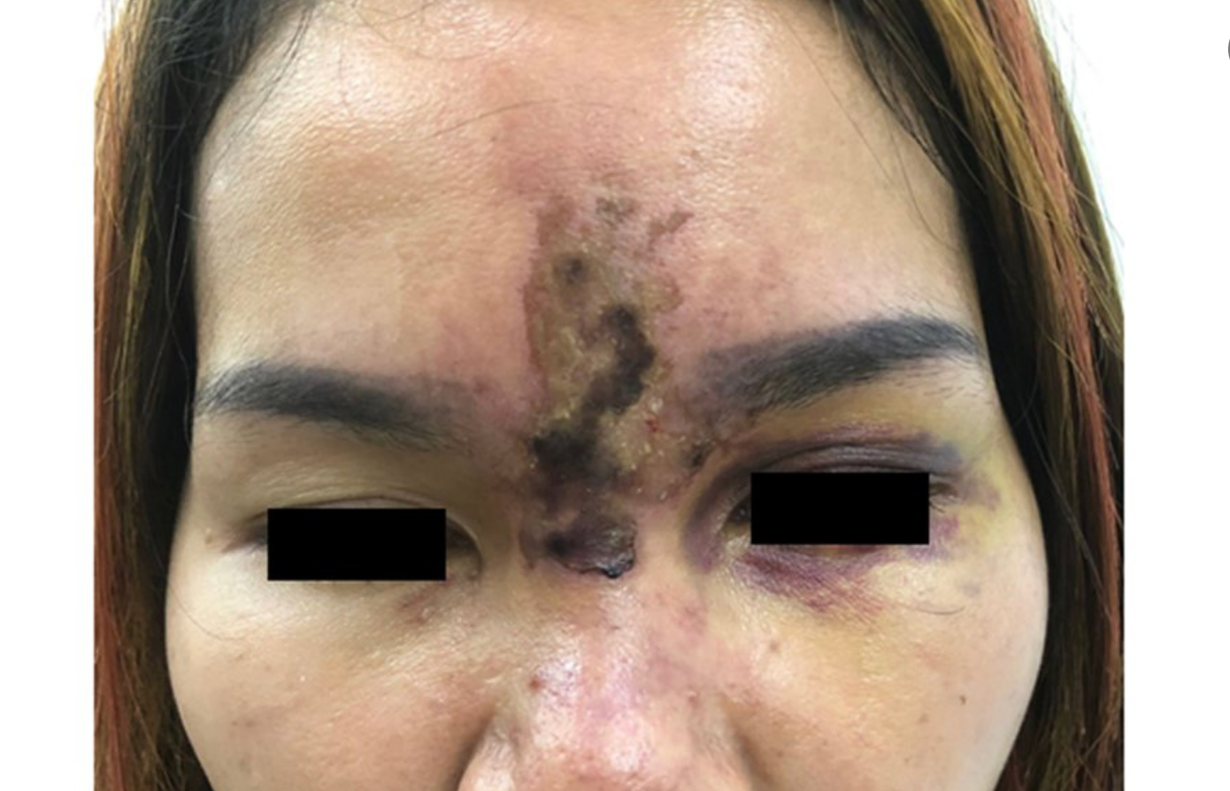 Một ca tai biến hỏng luôn mặt sau khi tiêm filler tại một spa. Bệnh nhân sau đó nhập viện tại BV Da liễu TPHCM điều trị screenshot-2025-09-16-at-100438.png