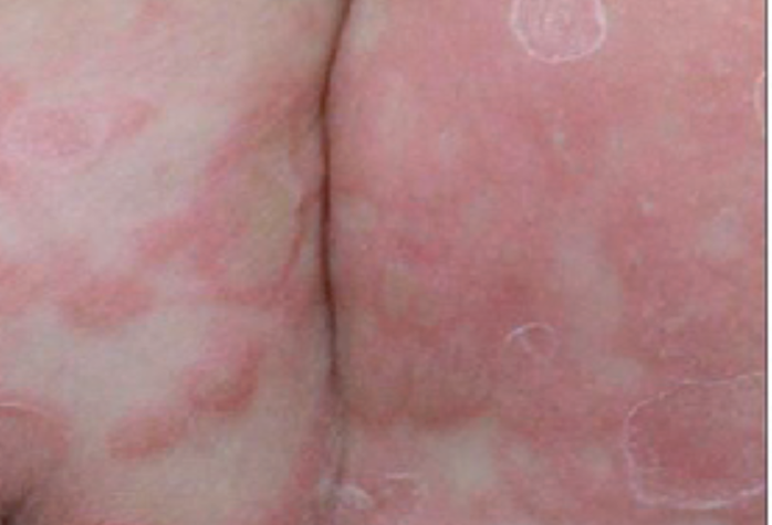 Bé trai 3 tuổi bị giang mai bẩm sinh dù không có triệu chứng - Ảnh 3.