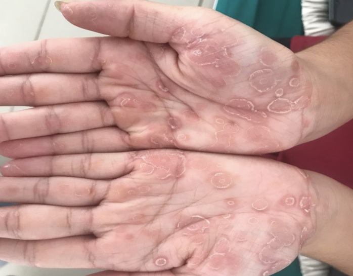 Bé trai 3 tuổi bị giang mai bẩm sinh dù không có triệu chứng - Ảnh 1.