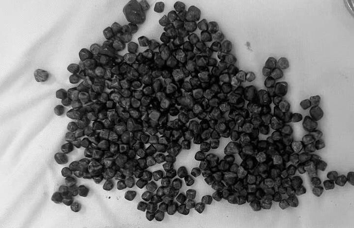 Số lượng sỏi khổng lồ được lấy ra khỏi túi mật của nữ Việt kiều.